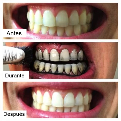 Cómo tener los dientes blancos ▷ Clínica Dental Naves