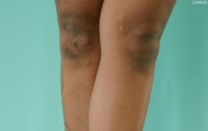 Foto de rodillas para ilustrar Los mejores ejercicios para reducir las rodillas gordas