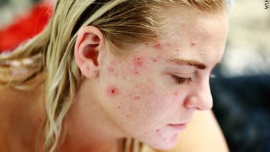 ¿Sabes cuál es la relación el acné y los órganos Te la decimos