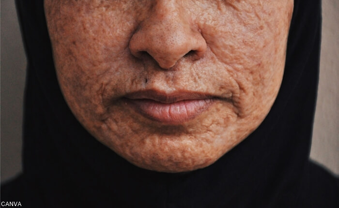Granos en la zona del bigote para ilustrar ¿Sabes cuál es la relación el acné y los órganos? Te la decimos