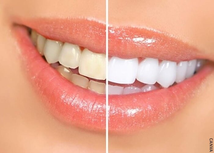 Foto de dientes antes y después del blanqueamiento