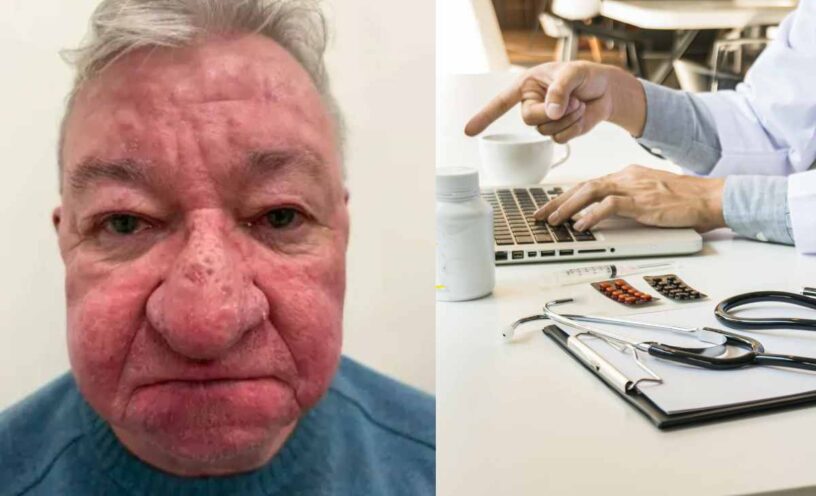 extraña enfermedad hizo que la nariz de un hombre creciera sin parar