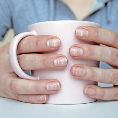 qué significan las manchas blancas en las uñas.