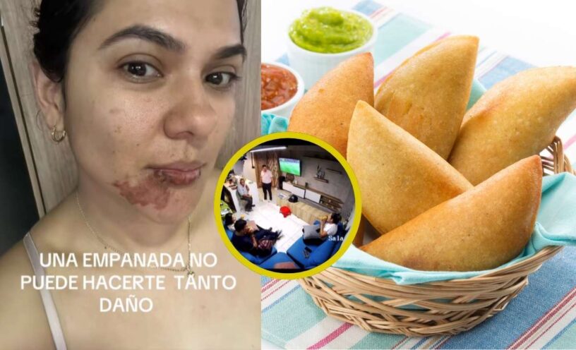 Video de la mujer que se le explotó una empanada mientras se la comía: Sufrió graves quemaduras